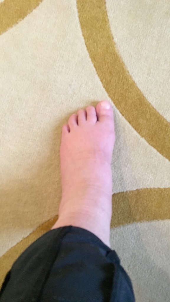 Swollen-Feet